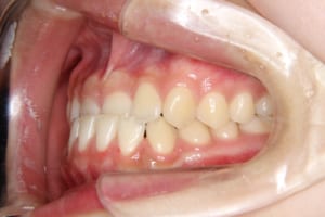 上顎前歯が舌側傾斜、下顎前歯が唇側転位しています